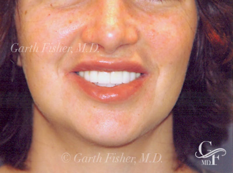 Lip Augmentation Before & After Gallery - Patient 252968 - Image 4
