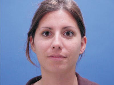 Chin Augmentation Before & After Gallery - Patient 678945 - Image 1