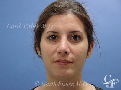 Chin Augmentation Before & After Gallery - Patient 678945 - Image 2