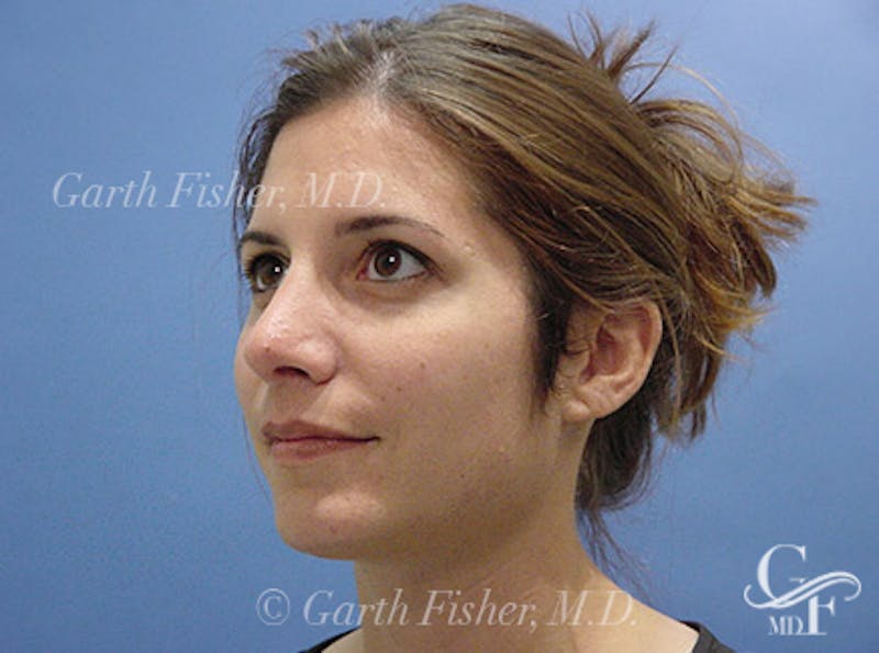 Chin Augmentation Before & After Gallery - Patient 678945 - Image 4