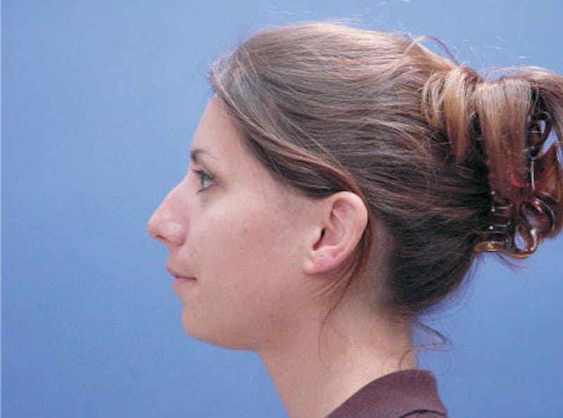 Chin Augmentation Before & After Gallery - Patient 678945 - Image 5