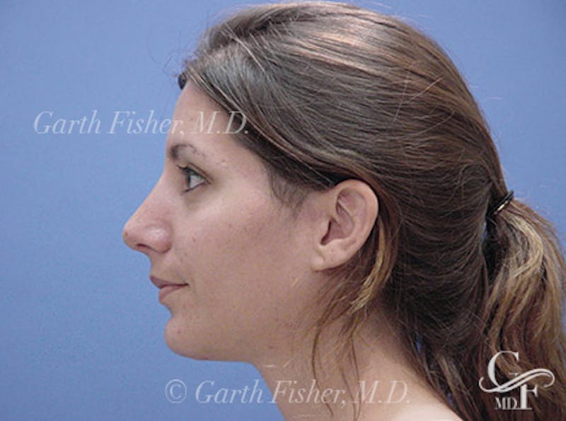 Chin Augmentation Before & After Gallery - Patient 678945 - Image 6