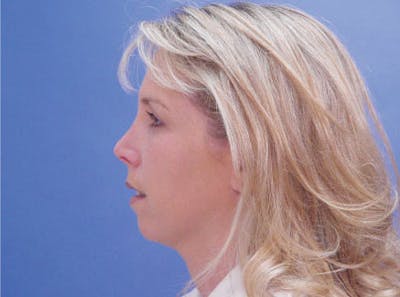 Chin Augmentation Before & After Gallery - Patient 617797 - Image 1