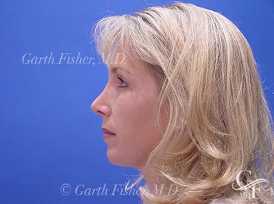 Chin Augmentation Before & After Gallery - Patient 617797 - Image 2