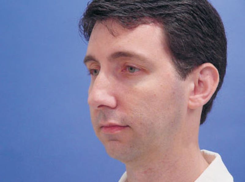 Chin Augmentation Before & After Gallery - Patient 702355 - Image 1