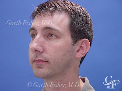 Chin Augmentation Before & After Gallery - Patient 702355 - Image 2
