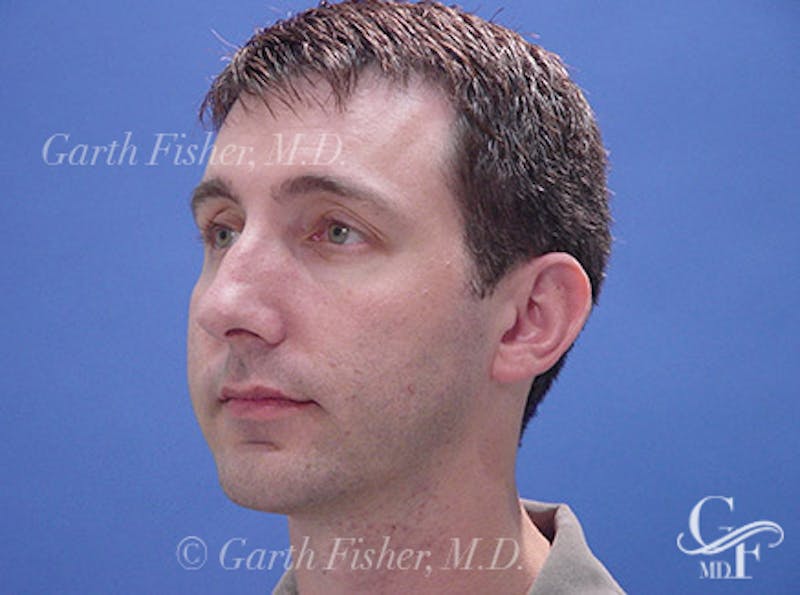 Chin Augmentation Before & After Gallery - Patient 702355 - Image 2