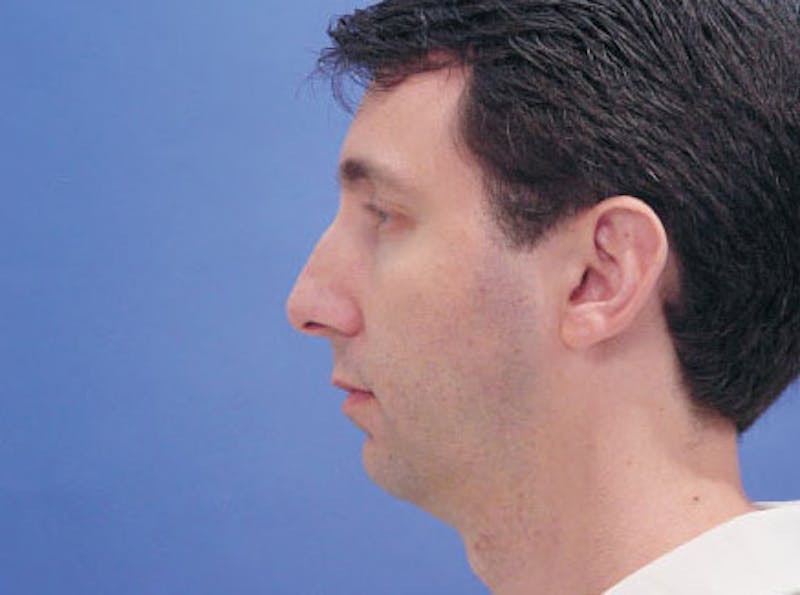 Chin Augmentation Before & After Gallery - Patient 702355 - Image 3
