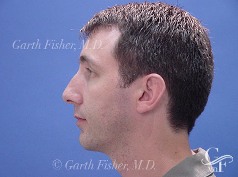 Chin Augmentation Before & After Gallery - Patient 702355 - Image 4