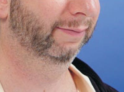 Chin Augmentation Before & After Gallery - Patient 183592 - Image 1