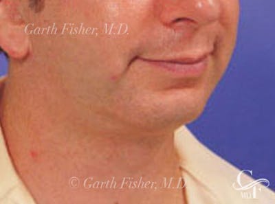 Chin Augmentation Before & After Gallery - Patient 183592 - Image 2