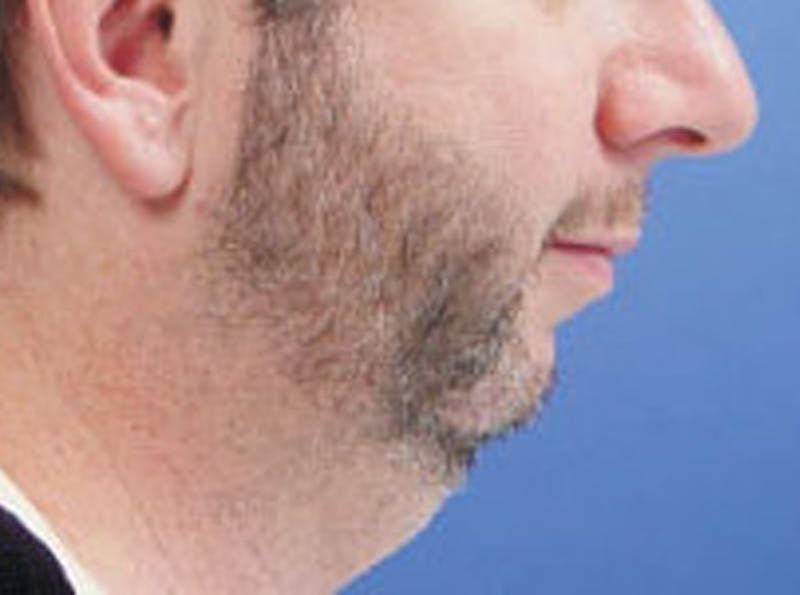 Chin Augmentation Before & After Gallery - Patient 183592 - Image 3