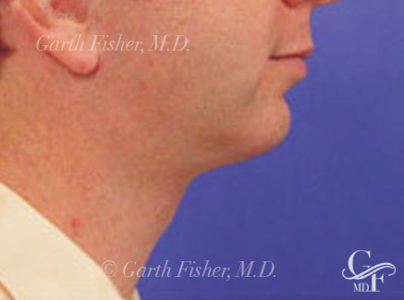 Chin Augmentation Before & After Gallery - Patient 183592 - Image 4