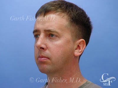 Chin Augmentation Before & After Gallery - Patient 337509 - Image 2