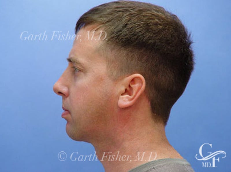 Chin Augmentation Before & After Gallery - Patient 337509 - Image 4