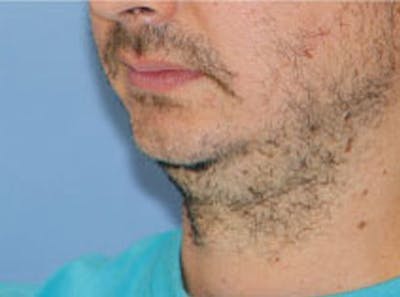 Chin Augmentation Before & After Gallery - Patient 365299 - Image 1