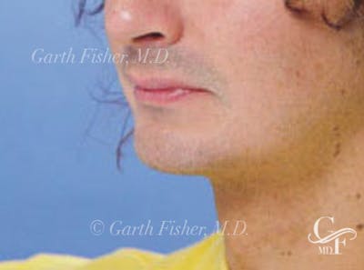Chin Augmentation Before & After Gallery - Patient 365299 - Image 2