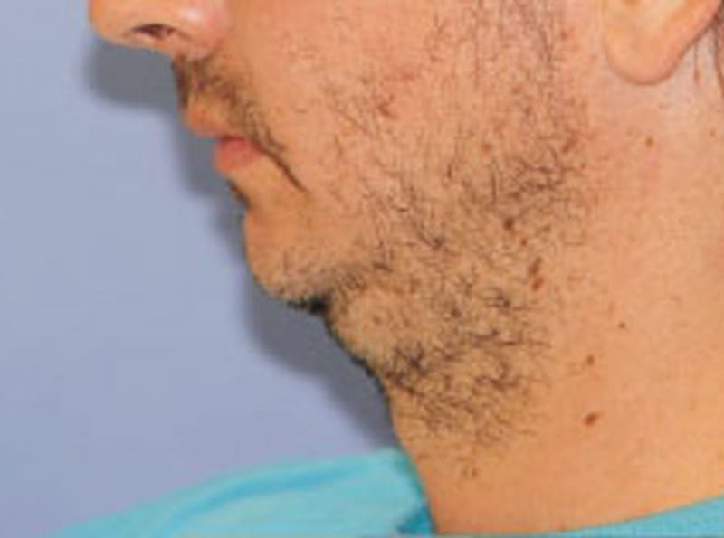 Chin Augmentation Before & After Gallery - Patient 365299 - Image 3
