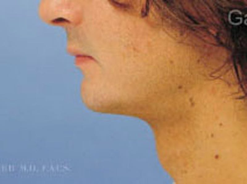 Chin Augmentation Before & After Gallery - Patient 365299 - Image 4