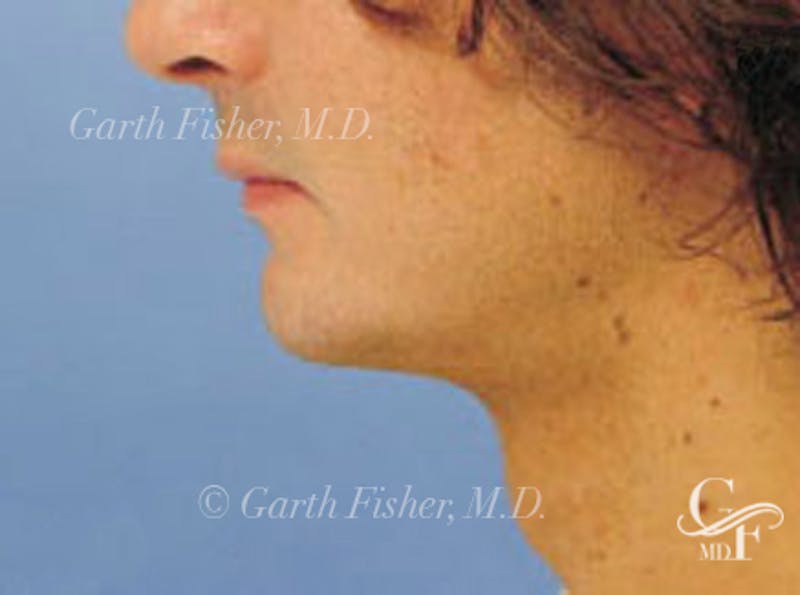 Chin Augmentation Before & After Gallery - Patient 365299 - Image 5