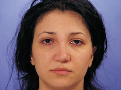Primary Rhinoplasty Before & After Gallery - Patient 173418 - Image 1
