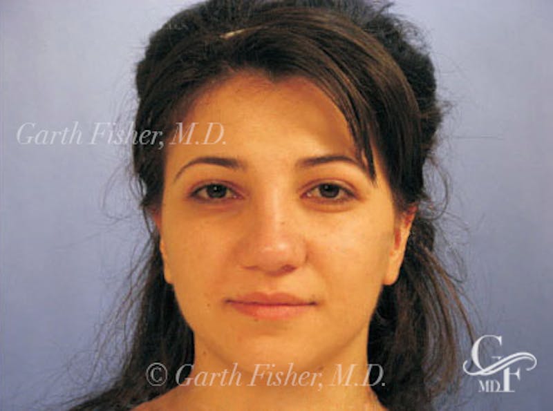 Primary Rhinoplasty Before & After Gallery - Patient 173418 - Image 2