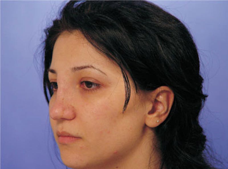 Primary Rhinoplasty Before & After Gallery - Patient 173418 - Image 3