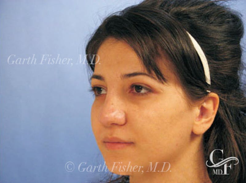 Primary Rhinoplasty Before & After Gallery - Patient 173418 - Image 4
