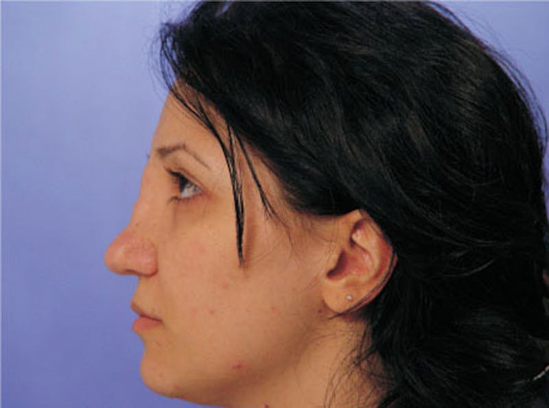 Primary Rhinoplasty Before & After Gallery - Patient 173418 - Image 5