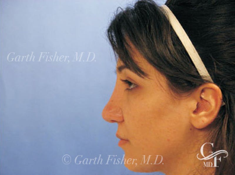 Primary Rhinoplasty Before & After Gallery - Patient 173418 - Image 6