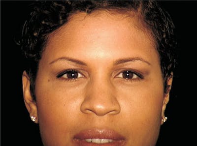 Ethnic Rhinoplasty Before & After Gallery - Patient 239204 - Image 1