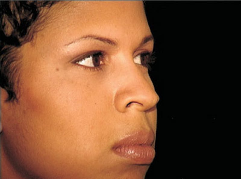 Ethnic Rhinoplasty Before & After Gallery - Patient 239204 - Image 3