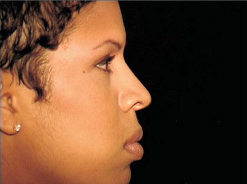 Ethnic Rhinoplasty Before & After Gallery - Patient 239204 - Image 5