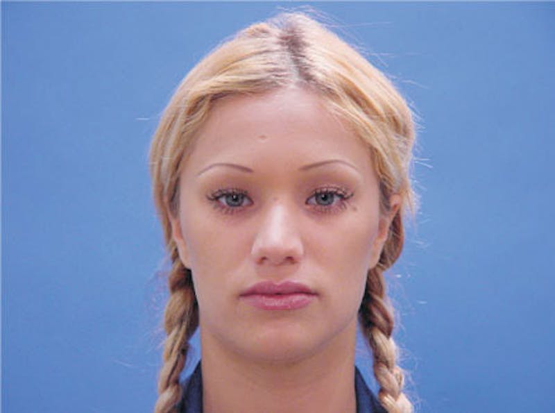 Primary Rhinoplasty Before & After Gallery - Patient 460893 - Image 1