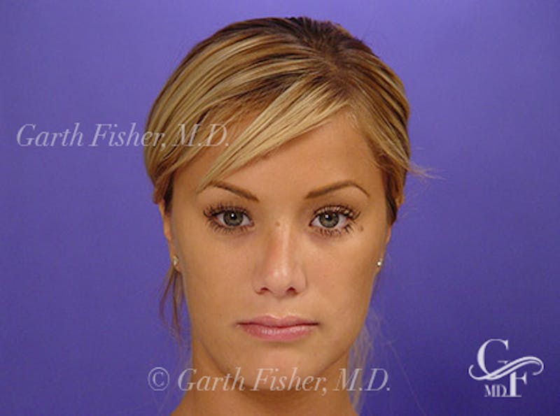 Primary Rhinoplasty Before & After Gallery - Patient 460893 - Image 2