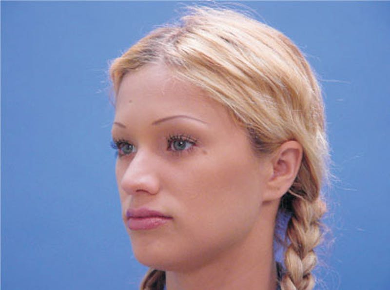 Primary Rhinoplasty Before & After Gallery - Patient 460893 - Image 3