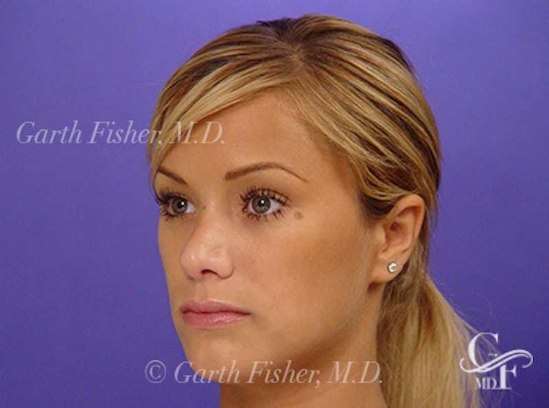 Primary Rhinoplasty Before & After Gallery - Patient 460893 - Image 4
