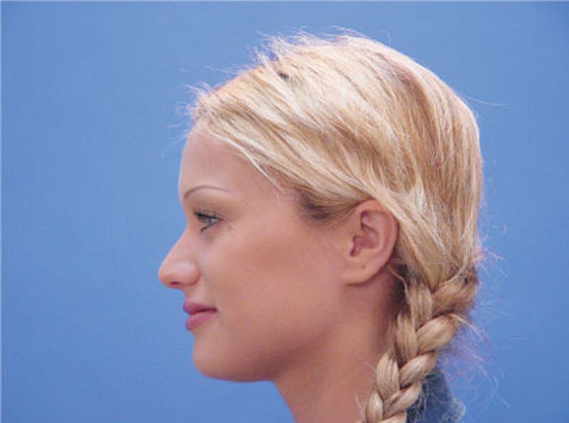 Primary Rhinoplasty Before & After Gallery - Patient 460893 - Image 5