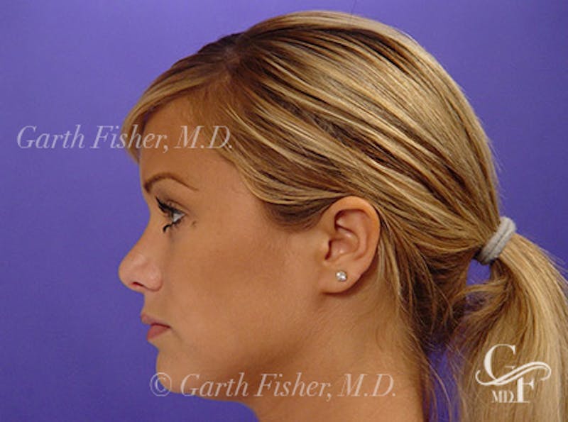 Primary Rhinoplasty Before & After Gallery - Patient 460893 - Image 6