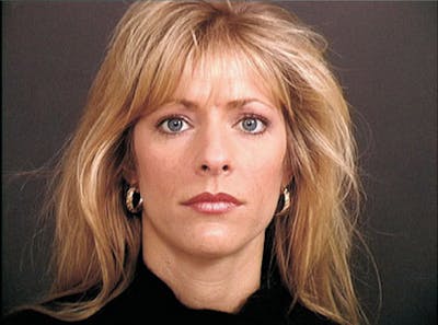 Primary Rhinoplasty Before & After Gallery - Patient 376764 - Image 1