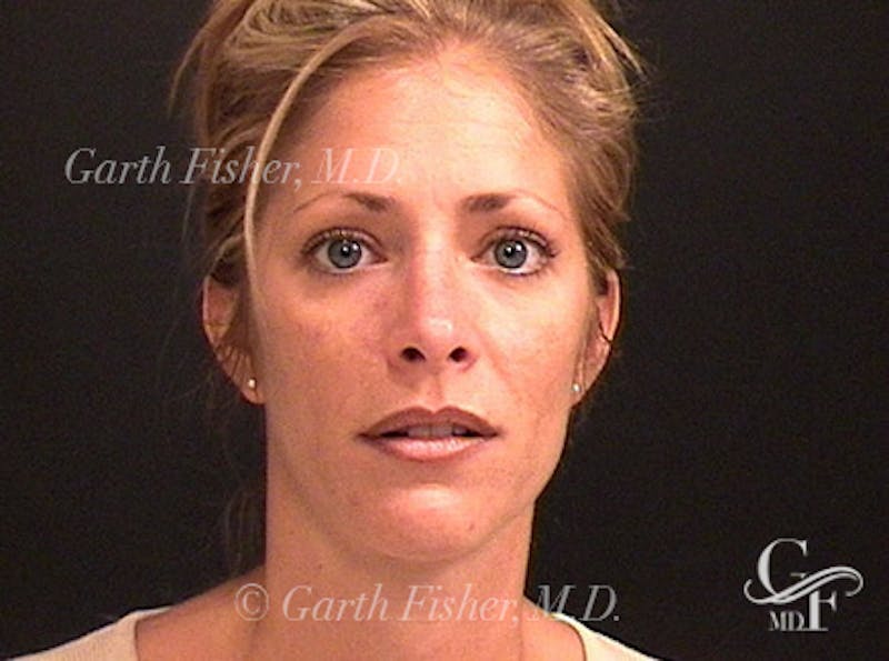 Primary Rhinoplasty Before & After Gallery - Patient 376764 - Image 2