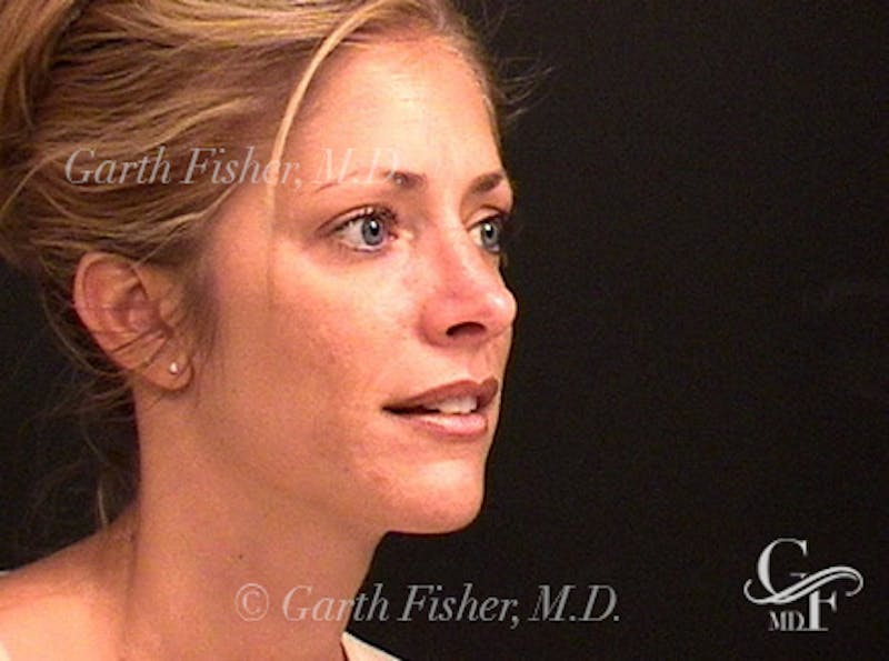 Primary Rhinoplasty Before & After Gallery - Patient 376764 - Image 4