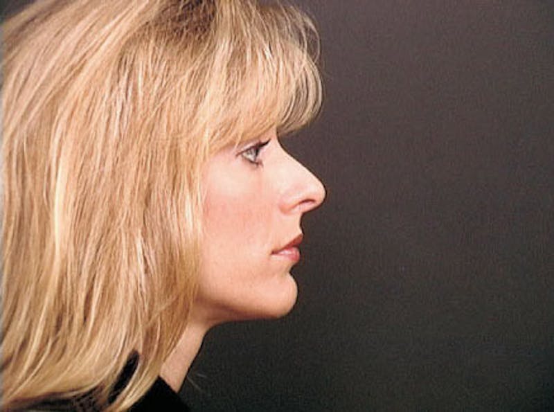 Primary Rhinoplasty Before & After Gallery - Patient 376764 - Image 5