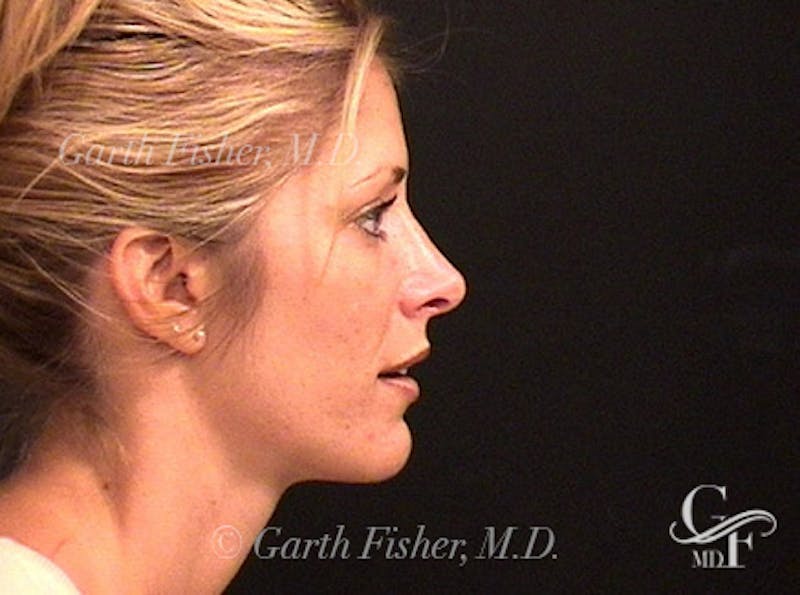 Primary Rhinoplasty Before & After Gallery - Patient 376764 - Image 6