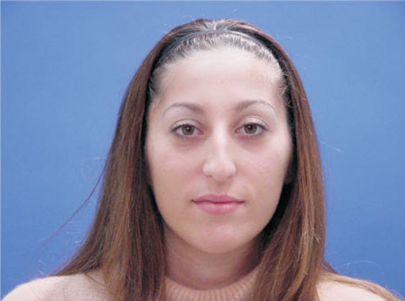 Primary Rhinoplasty Before & After Gallery - Patient 293090 - Image 1