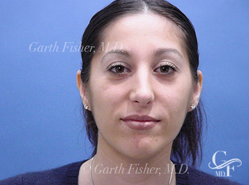Primary Rhinoplasty Before & After Gallery - Patient 293090 - Image 2