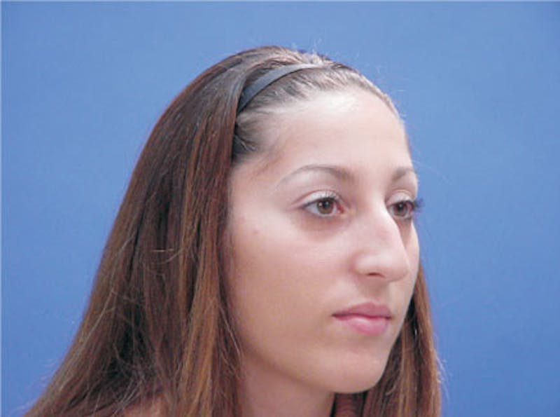 Primary Rhinoplasty Before & After Gallery - Patient 293090 - Image 3