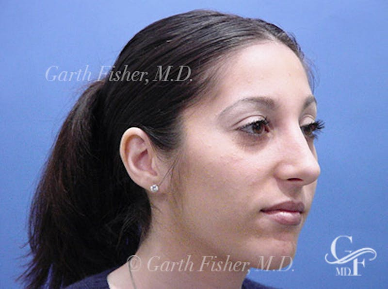 Primary Rhinoplasty Before & After Gallery - Patient 293090 - Image 4