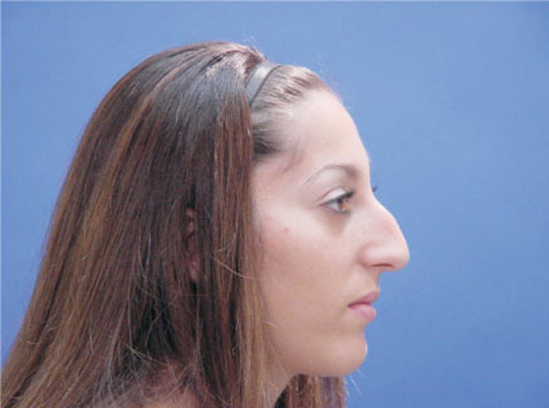 Primary Rhinoplasty Before & After Gallery - Patient 293090 - Image 5