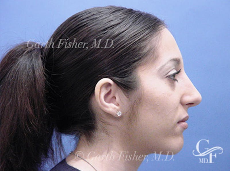 Primary Rhinoplasty Before & After Gallery - Patient 293090 - Image 6